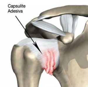 capsulite-adesiva-spalla