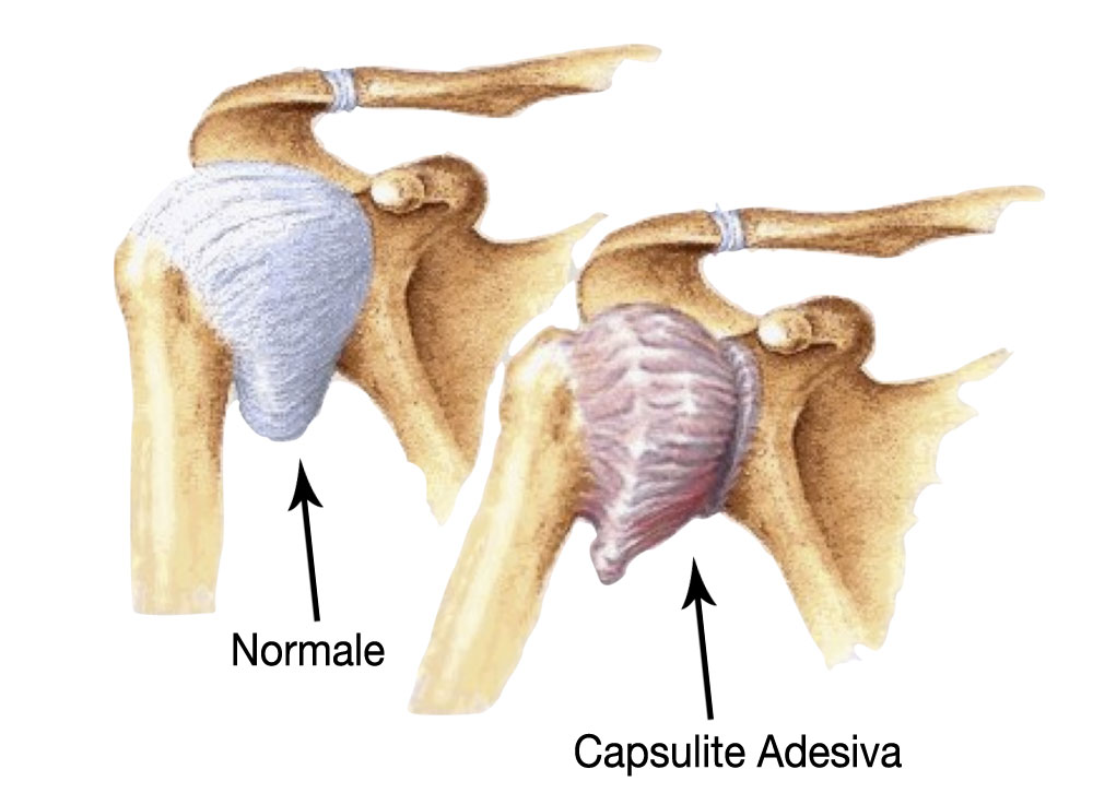 spalla-con-capsulite-adesiva