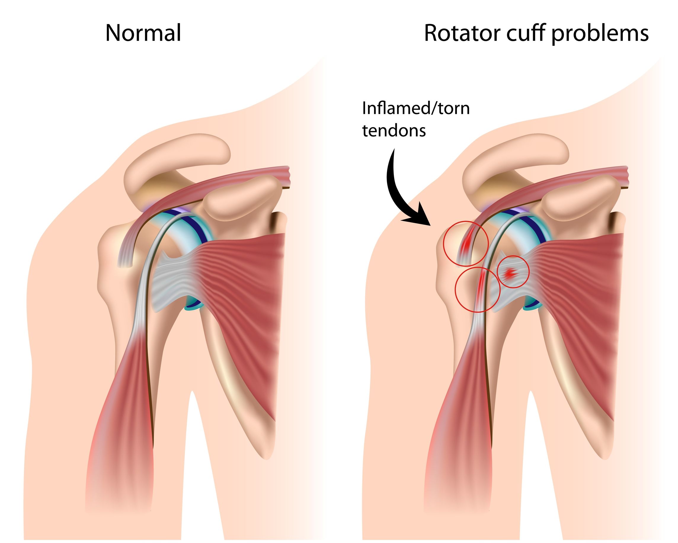 11271328 - shoulder impingement